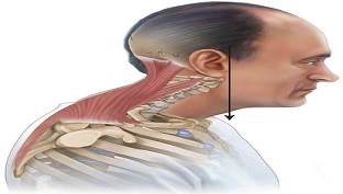 لوردوز گردن درمان گودی و جلو بودن گردن با فیزیوتراپی و ورزش