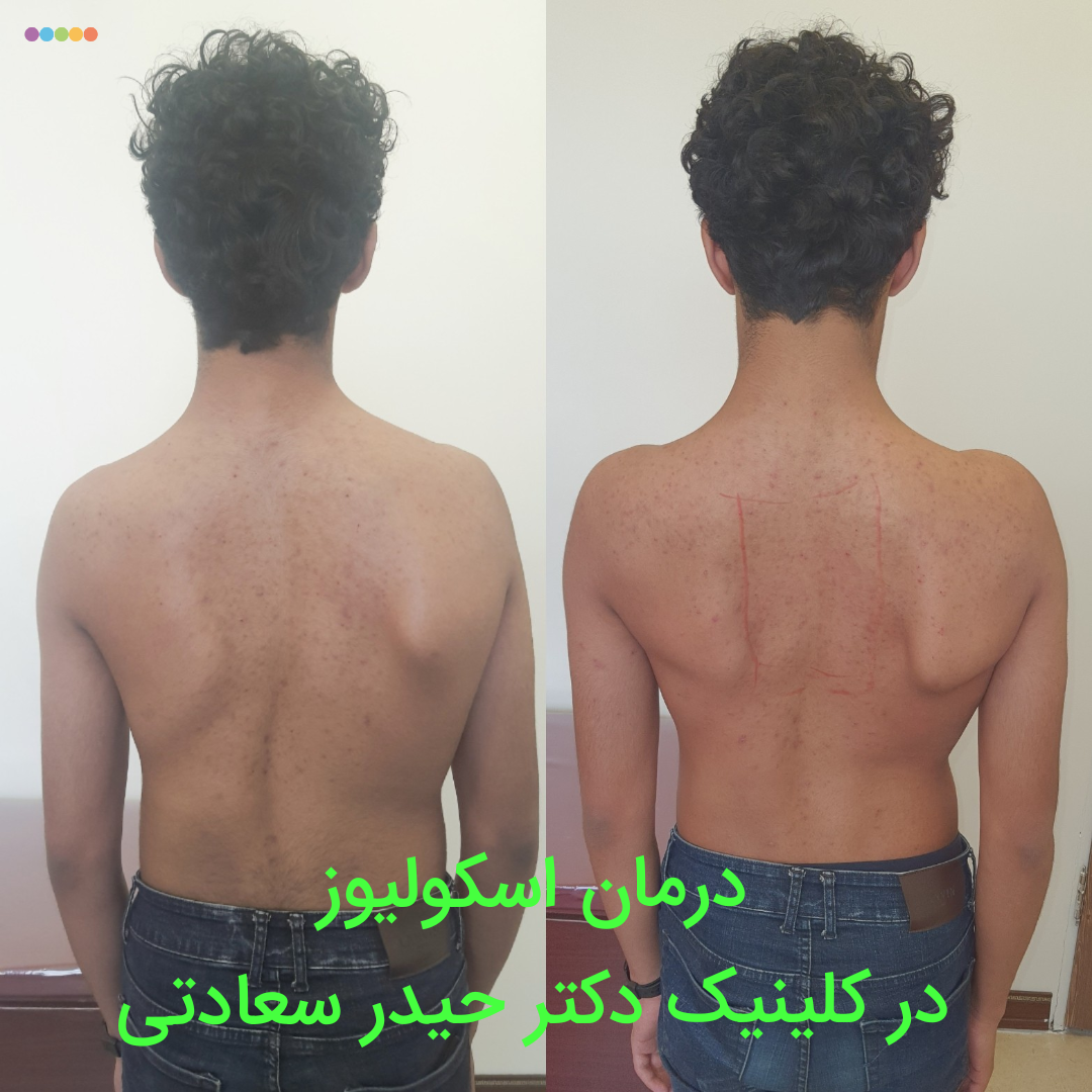 درمان اسکولیوز در کلینیک دکتر سعادتی