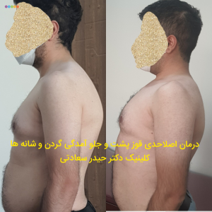 درمان قوز پشت در کلینیک دکتر سعادتی