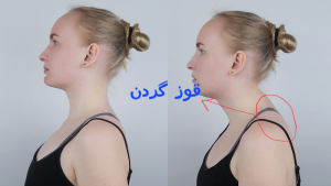 درمان قوز گردن در کلینیک دکار سعادتی