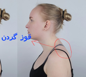 درمان قوز گردن در کلینیک دکار سعادتی