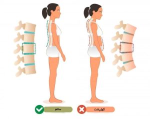 درمان اصلاح قوز پشتی