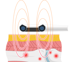 درمان القاء مغناطیسی برون بدنی