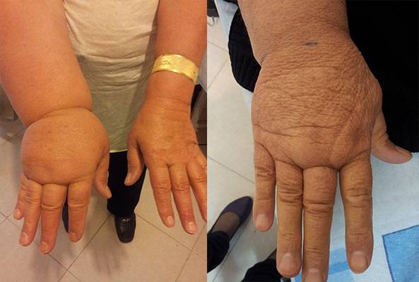 درمان لنف ادم مزمن