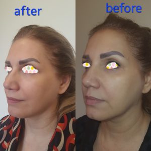 درمان شلی پوست صورت در کلینیک دکتر سعادتی