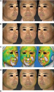 اثرات سفت کردن پوست صورت