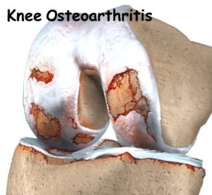 تخریب غضروف زانو