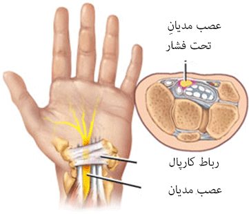 سندرم مچ دست