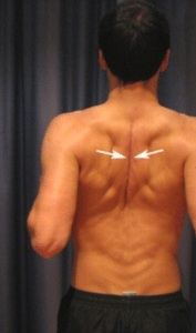 پارگی دیسک گردن