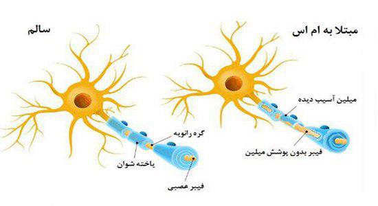 علت ابتلا به ام اس
