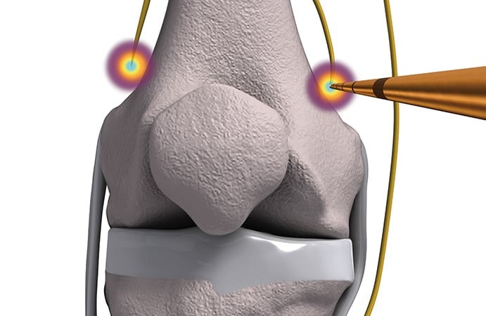 انواع رادیوفرکوئنسی
