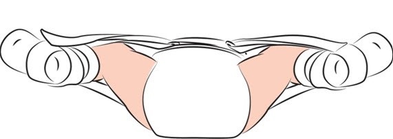 بازتوانی بدون جراحی برای دیسپلازی لگن در کودکان