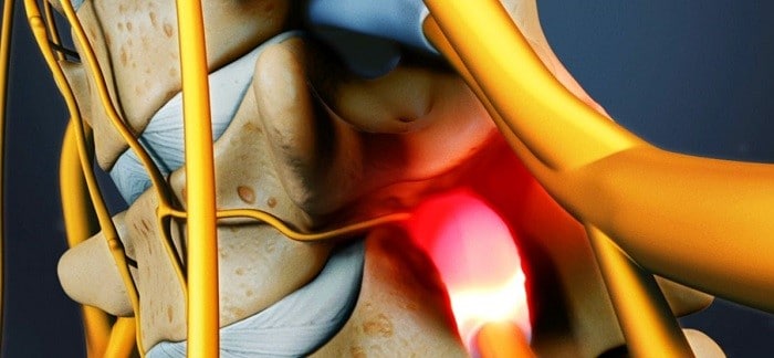 تنگی کانال نخاعی