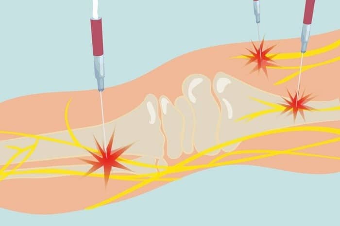 در طول عمل چه اتفاقی می‌افتد