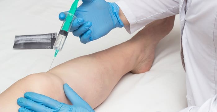 روش انجام اوزون تراپی