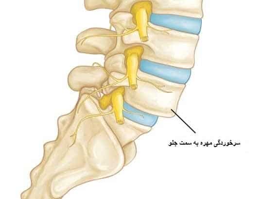 سرخوردگی مهره ها