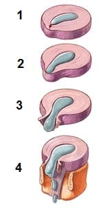 مراحل پارگی دیسک گردن 